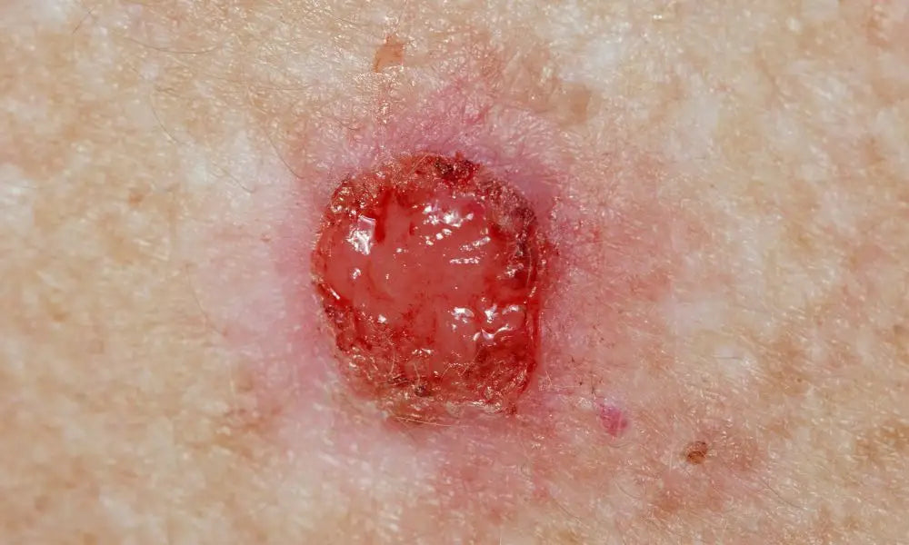Qué es y cuáles son los tipos de cáncer de piel? - MatchTrial